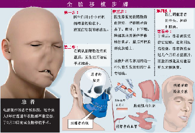 西班牙成功完成世界首例全臉移植術(shù) 患者因車禍毀容