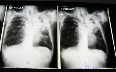 Study links smoking to millions of TB deaths